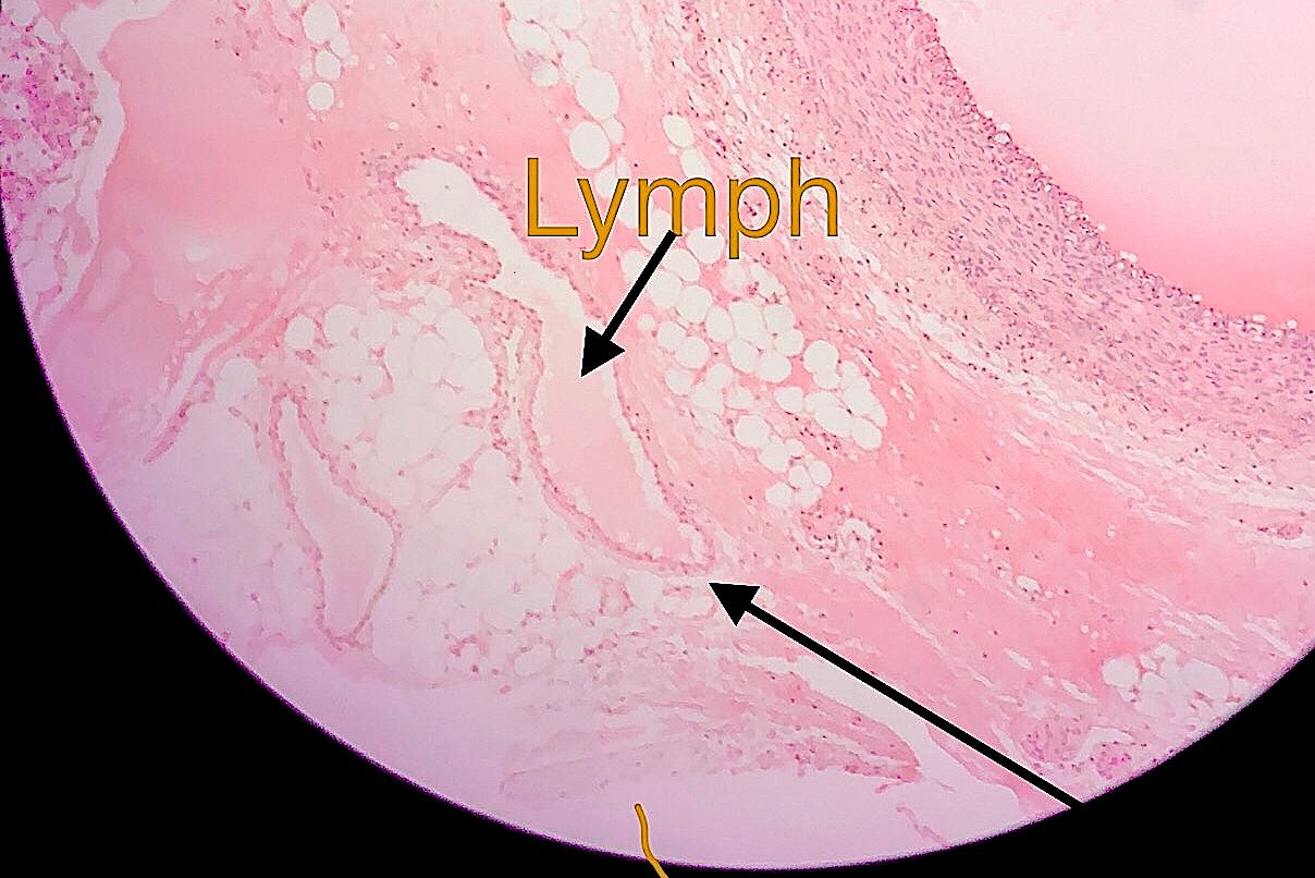 lymph vessel