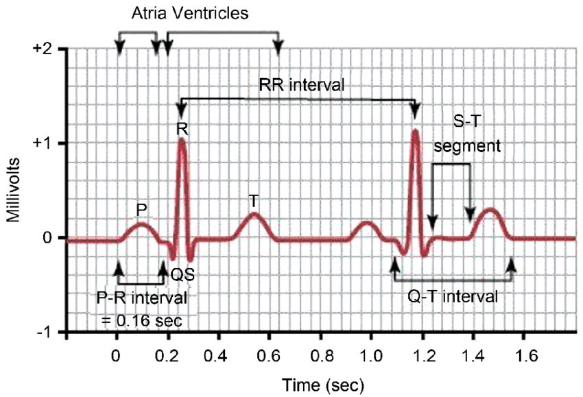 EKG